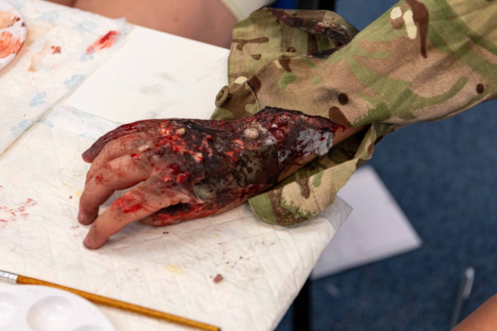 Burn moulage to the hand and forearm, dressed through a combat uniform sleeve