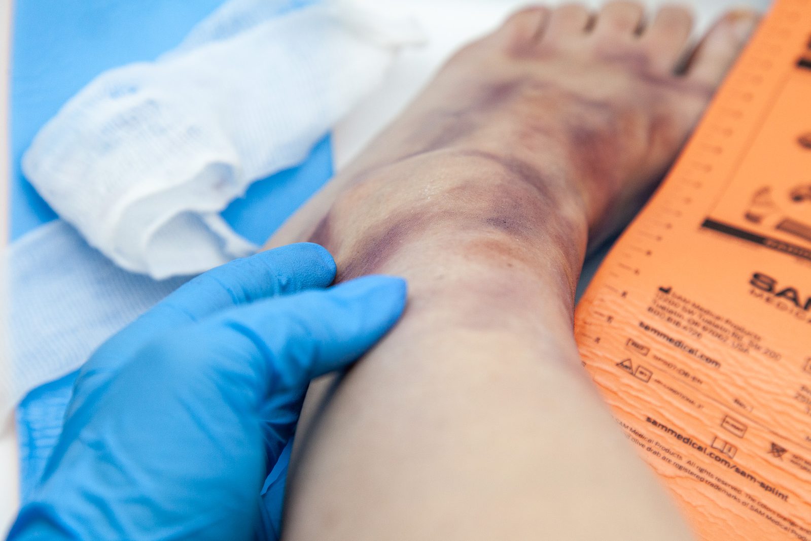 A gloved hand assessing extensive bruising across an ankle and foot, an orange moldable splint alongside on the trolley