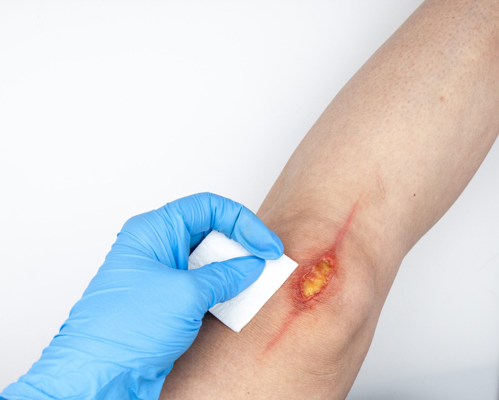 A gloved hand swabbing an open surgical wound on a knee
