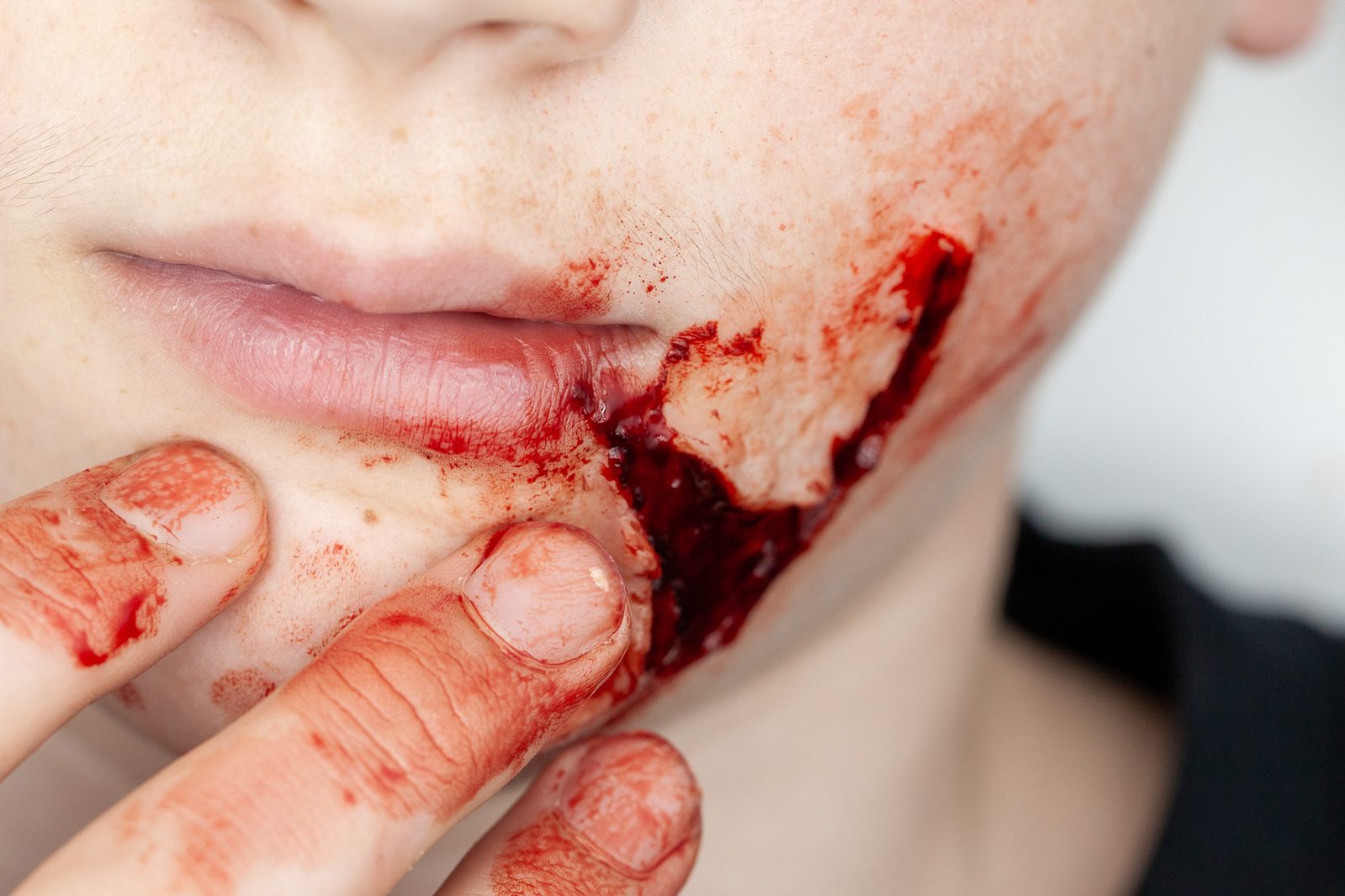 A deep laceration across the jaw and cheek with heavy bleeding, a hand held at the edge of the wound
