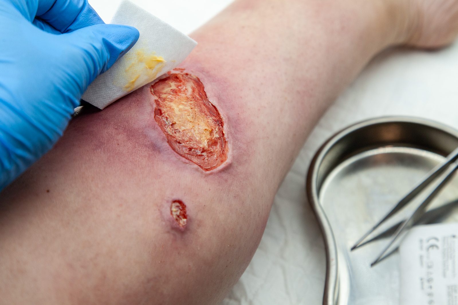 A gloved hand swabbing a leg ulcer, a kidney dish and forceps on the trolley alongside