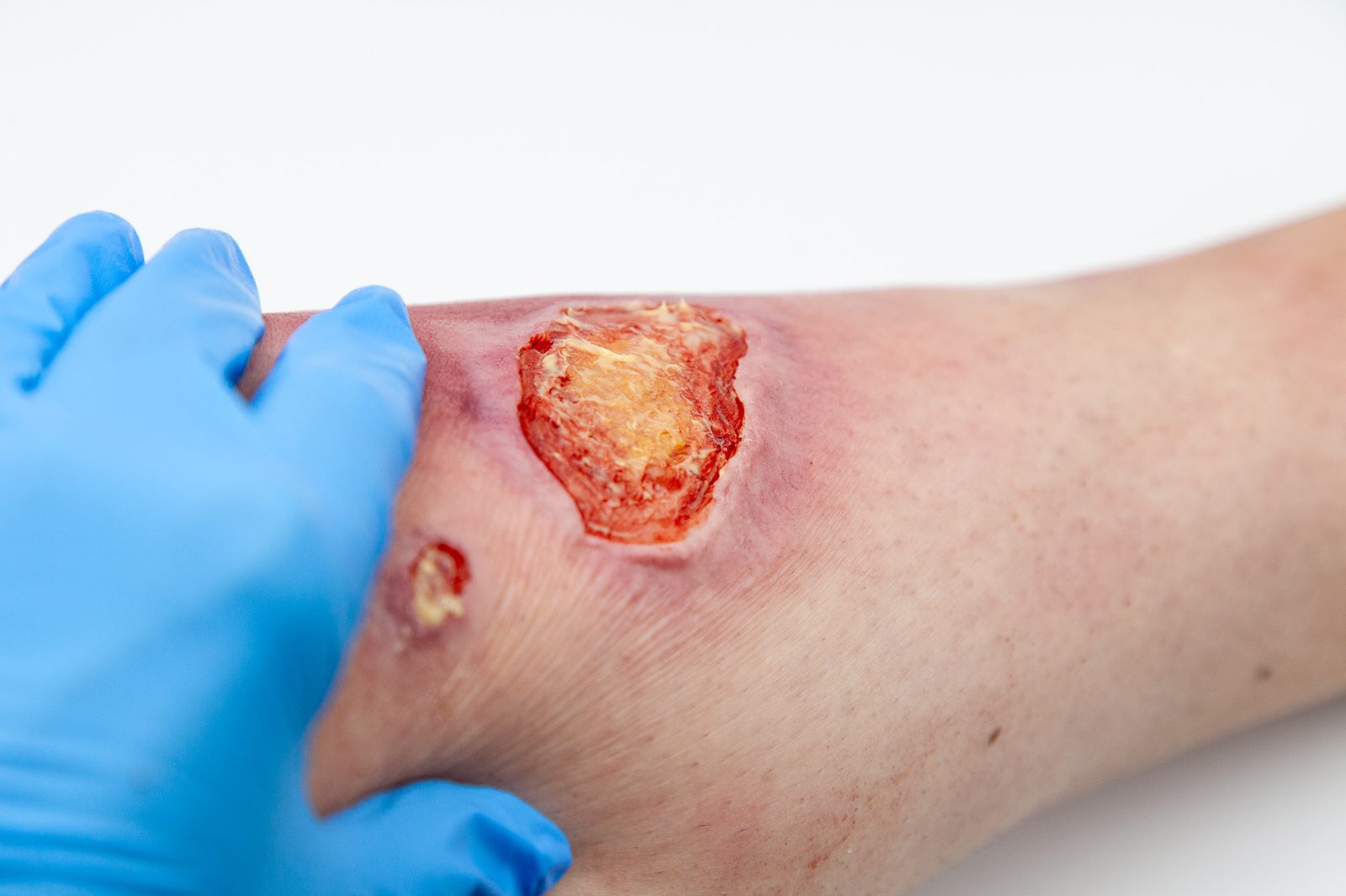 Cavity wound moulage on a lower leg, sloughy yellow wound bed inside an inflamed margin, a gloved hand supporting the limb