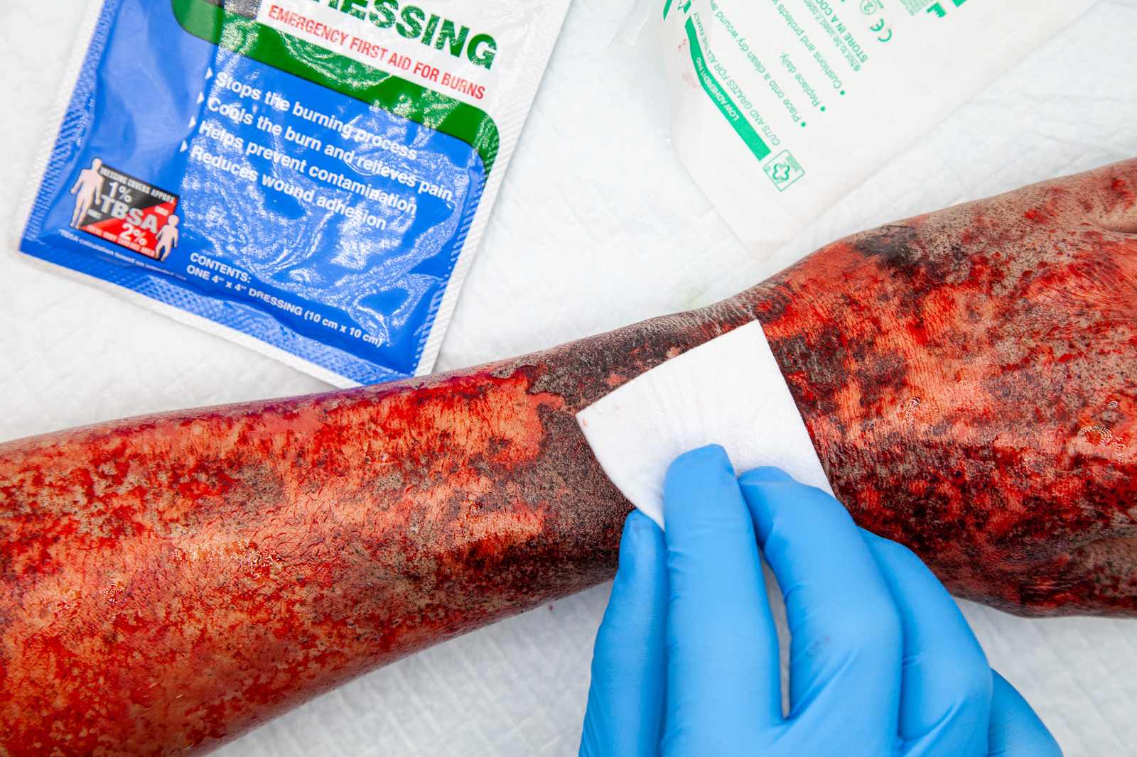 Flash burn moulage along a limb, soot and reddened skin blotted with a swab, an emergency burn dressing alongside