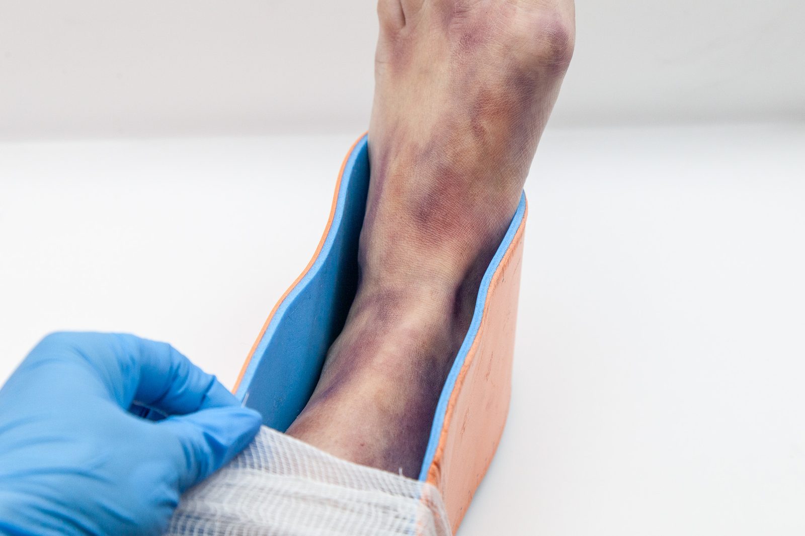 Deep bruising and swelling to an ankle and foot held in a moulded splint, a gloved hand securing a bandage