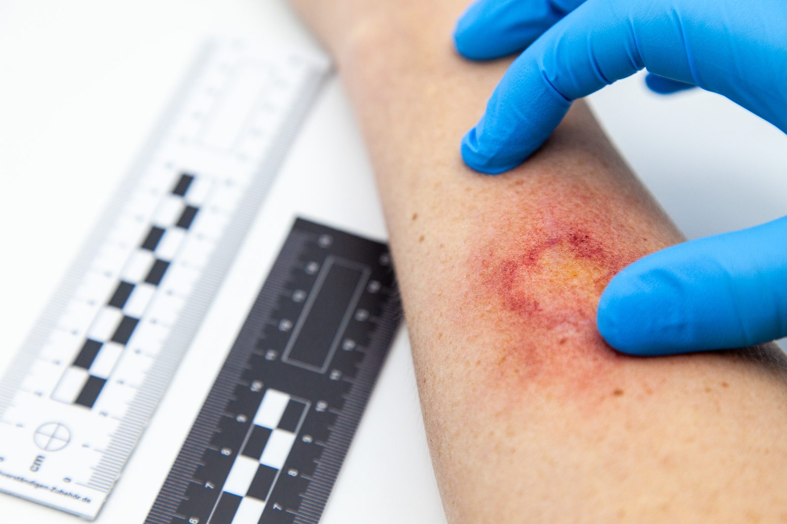 Patterned bruise moulage on a forearm, gloved fingers either side of it and forensic photographic scales laid alongside