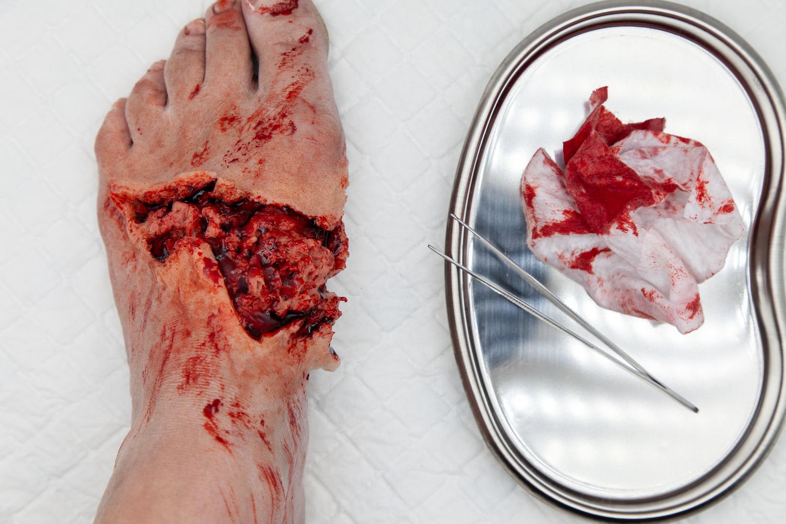 Open wound moulage across the top of a foot, tissue exposed and bleeding, with a kidney dish of bloodied gauze and forceps alongside