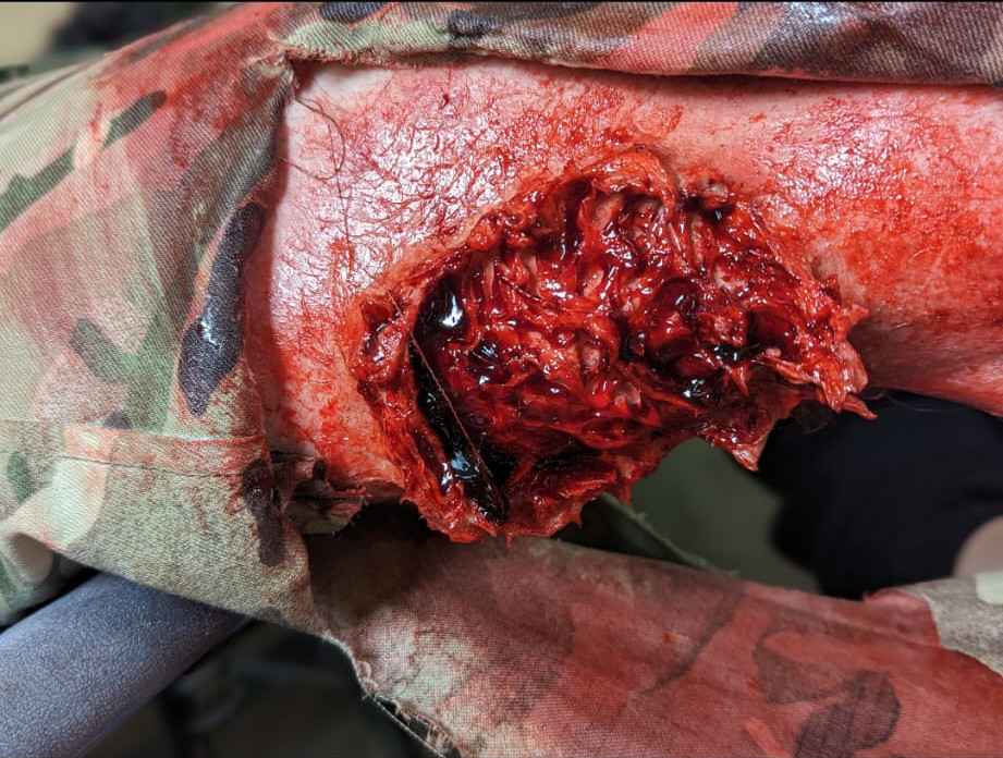Exit wound moulage to a limb, a deep ragged cavity seen through a cut-away camouflage uniform