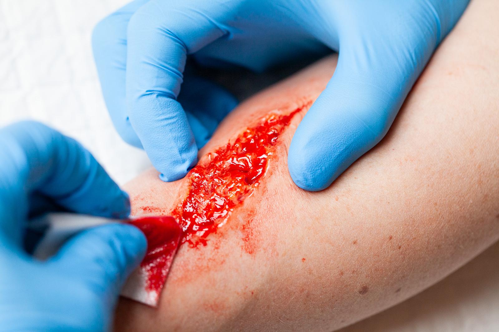 Open wound moulage on a forearm, being blotted with a dressing by gloved hands